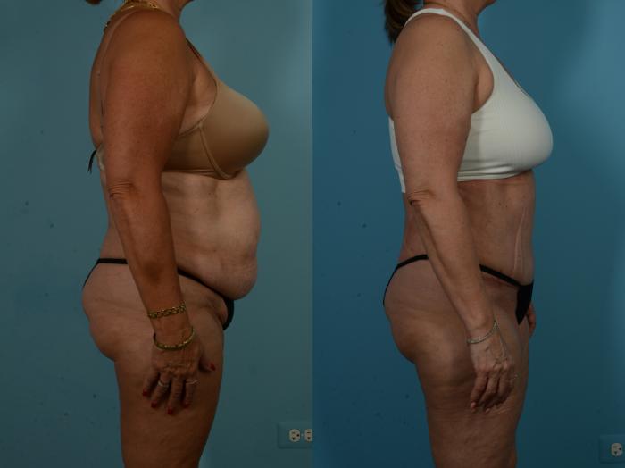 Before & After Tummy Tuck by Dr. Sinno Case 1065 Right Side View in Chicago, IL