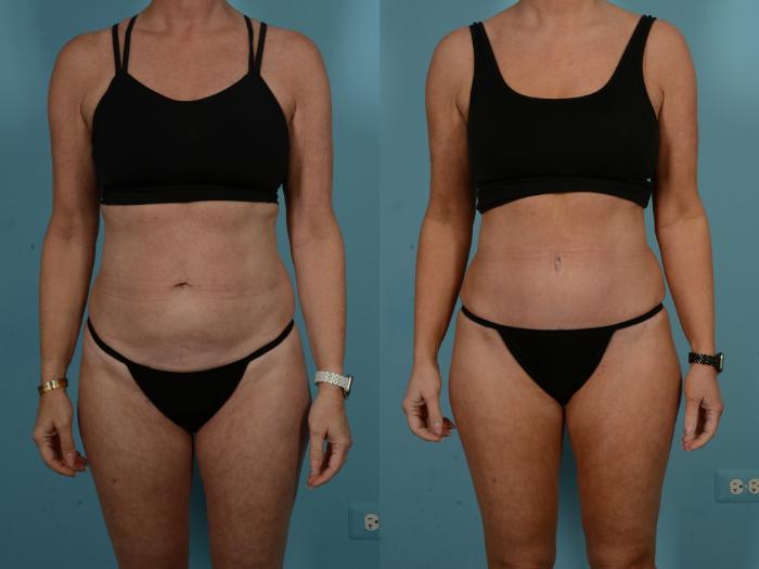 Before & After Tummy Tuck by Dr. Sinno Case 1098 Front View in Chicago, IL