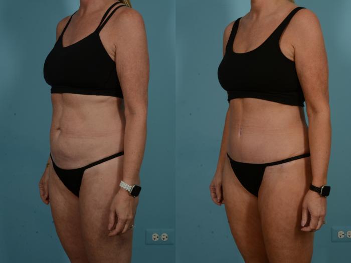 Before & After Tummy Tuck by Dr. Sinno Case 1098 Left Oblique View in Chicago, IL