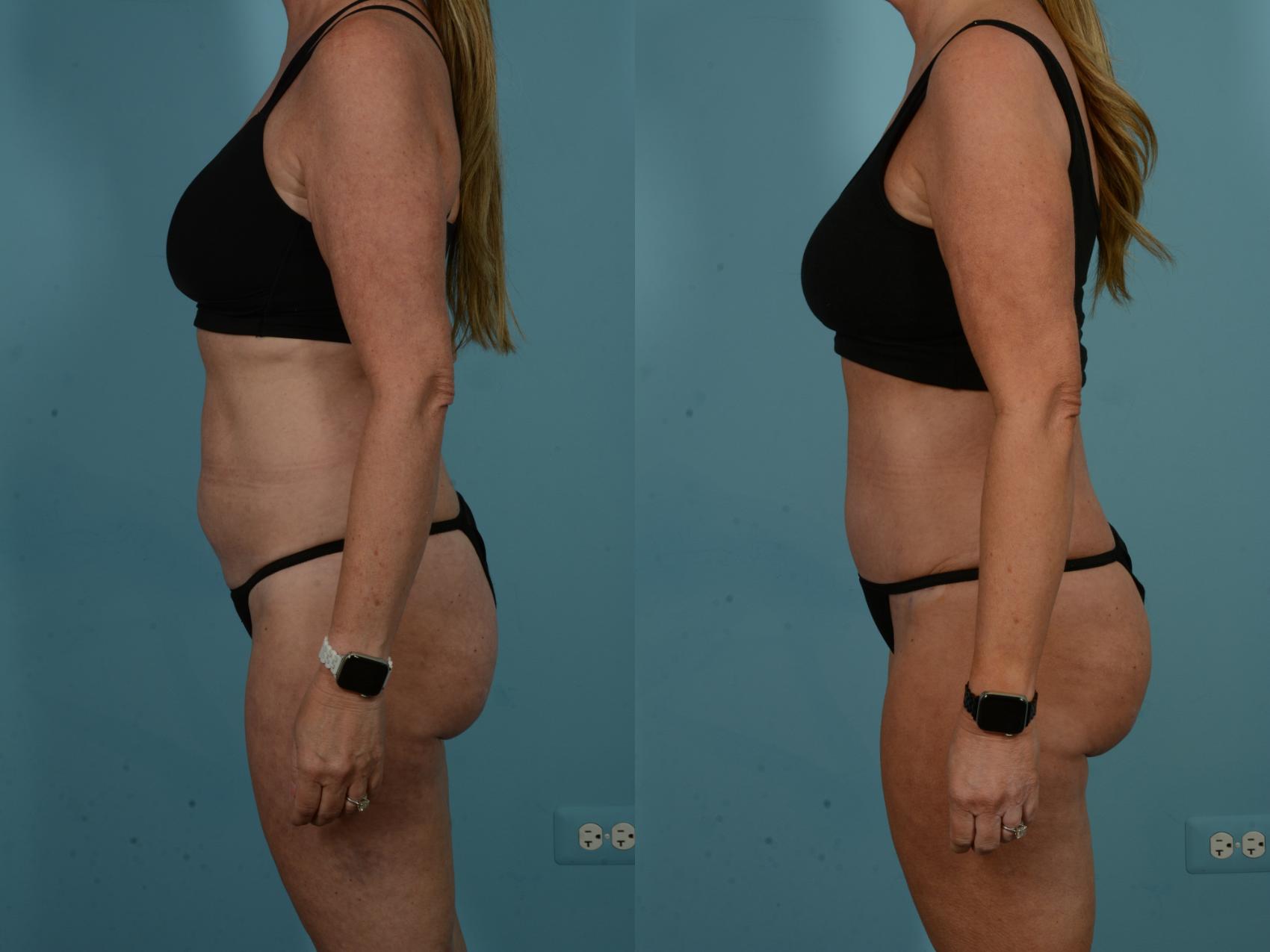 Before & After Tummy Tuck by Dr. Sinno Case 1098 Left Side View in Chicago, IL