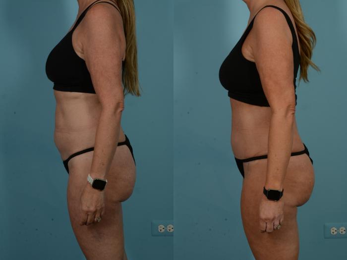 Before & After Tummy Tuck by Dr. Sinno Case 1098 Left Side View in Chicago, IL