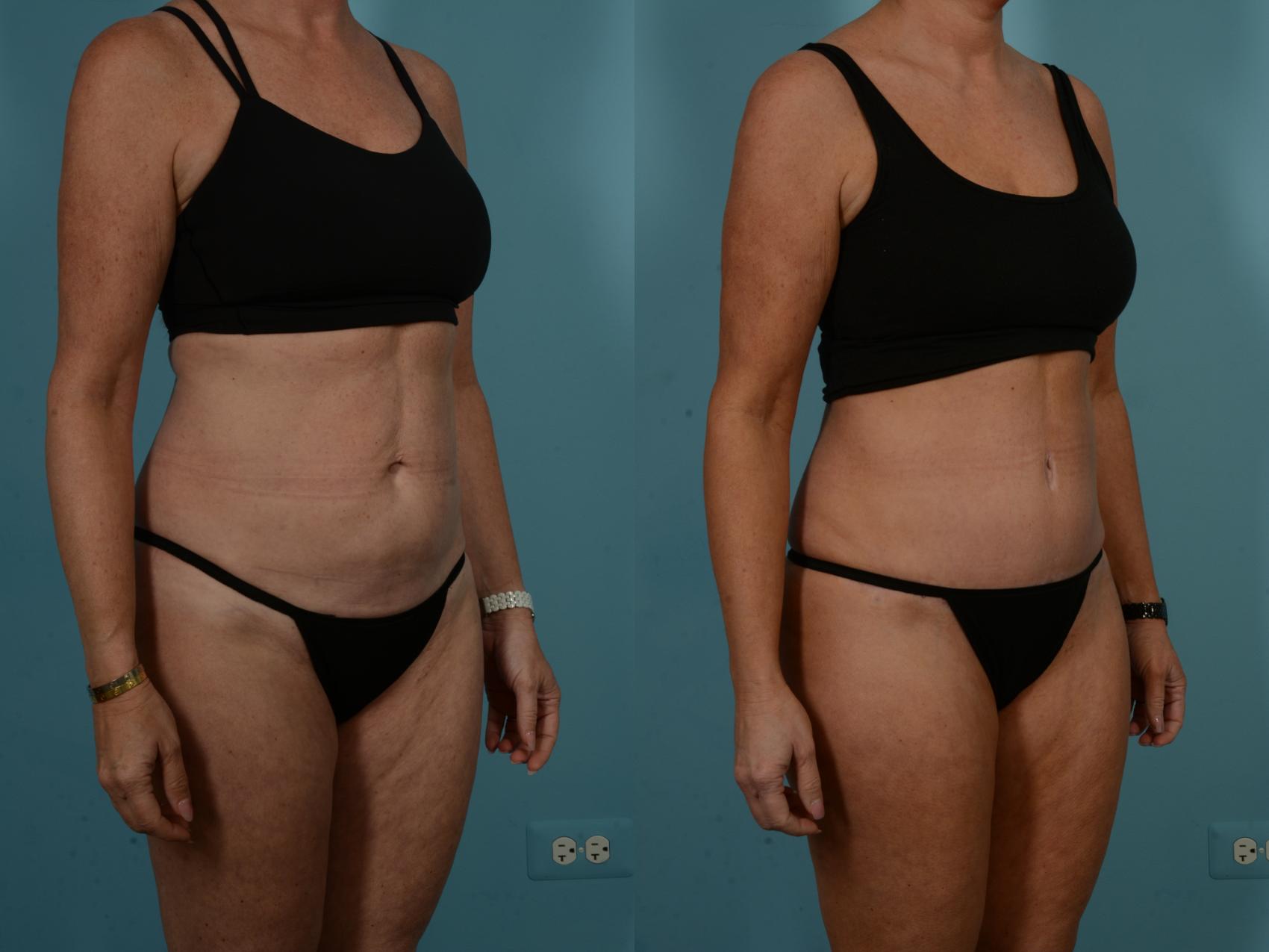 Before & After Tummy Tuck by Dr. Sinno Case 1098 Right Oblique View in Chicago, IL