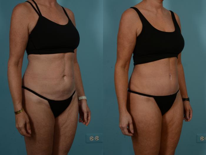 Before & After Tummy Tuck by Dr. Sinno Case 1098 Right Oblique View in Chicago, IL