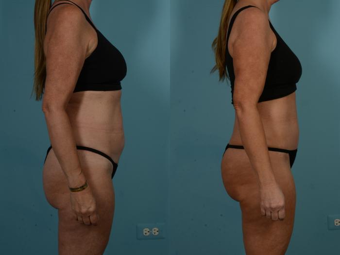 Before & After Tummy Tuck by Dr. Sinno Case 1098 Right Side View in Chicago, IL