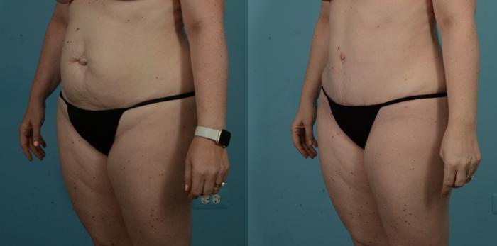 Before & After Tummy Tuck by Dr. Sinno Case 1099 Left Oblique View in Chicago, IL