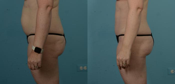 Before & After Tummy Tuck by Dr. Sinno Case 1099 Left Side View in Chicago, IL