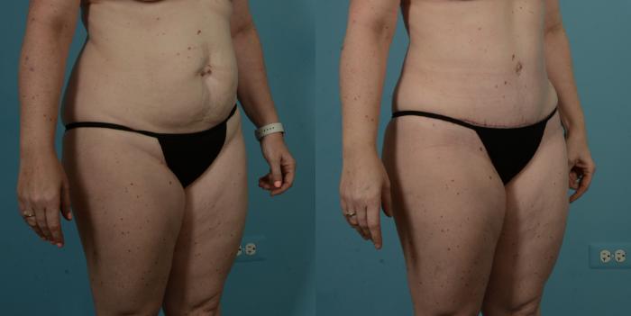 Before & After Tummy Tuck by Dr. Sinno Case 1099 Right Oblique View in Chicago, IL