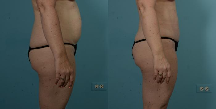 Before & After Tummy Tuck by Dr. Sinno Case 1099 Right Side View in Chicago, IL