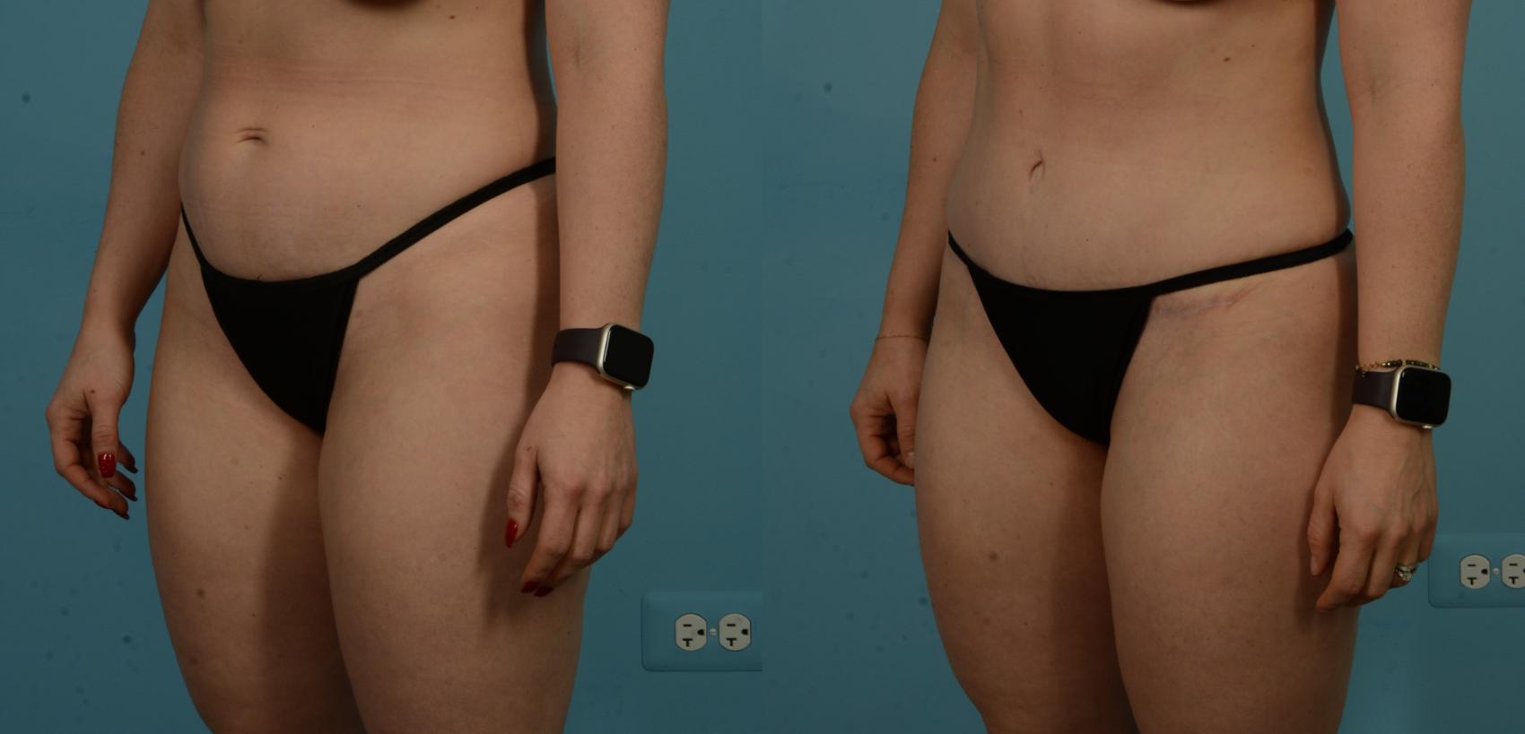 Before & After Tummy Tuck by Dr. Sinno Case 1100 Left Oblique View in Chicago, IL