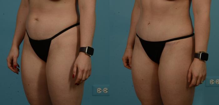 Before & After Tummy Tuck by Dr. Sinno Case 1100 Left Oblique View in Chicago, IL