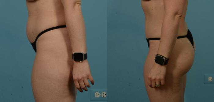 Before & After Tummy Tuck by Dr. Sinno Case 1100 Left Side View in Chicago, IL