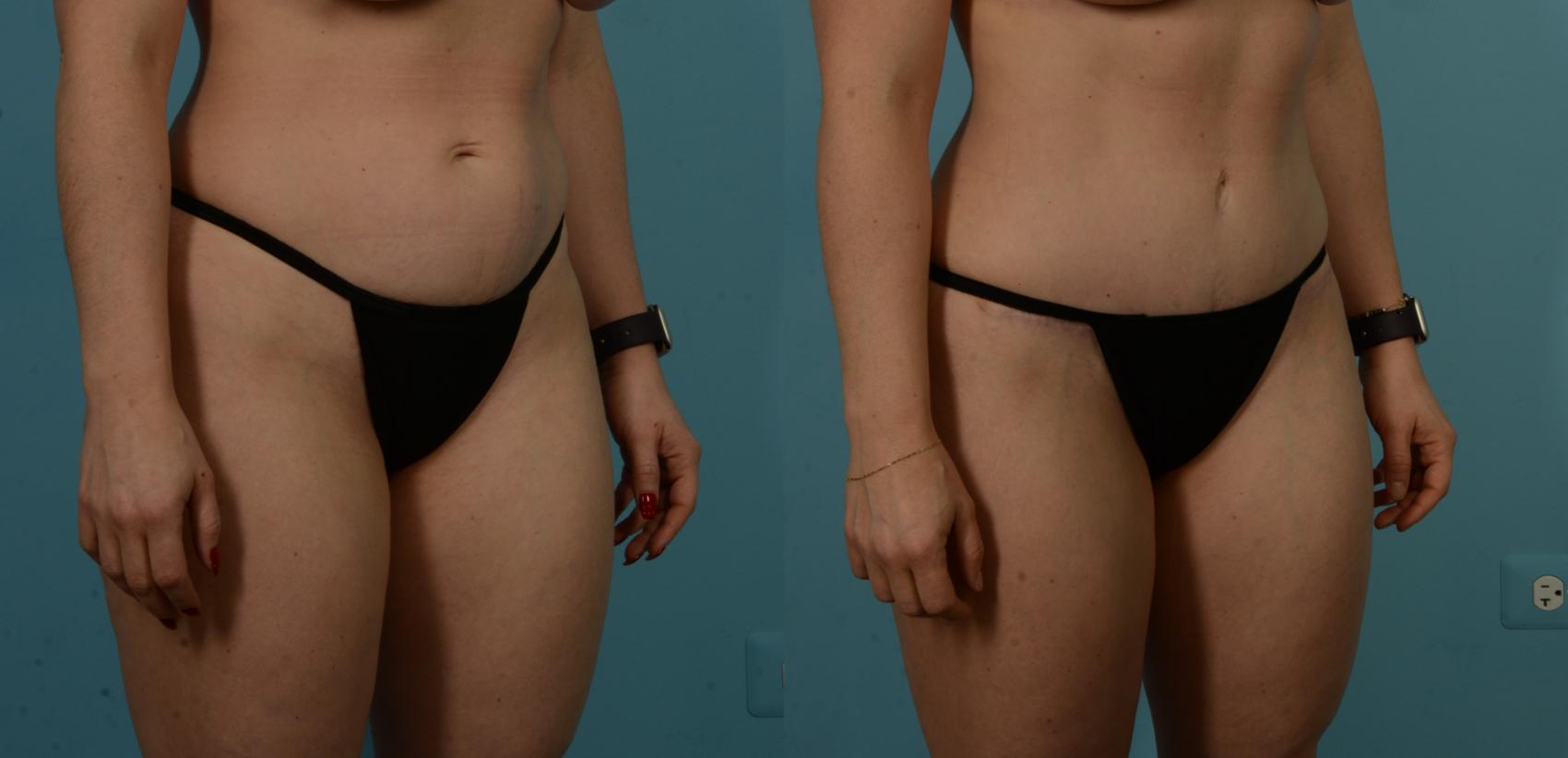 Before & After Tummy Tuck by Dr. Sinno Case 1100 Right Oblique View in Chicago, IL