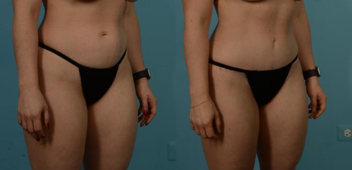 Before & After Tummy Tuck by Dr. Sinno Case 1100 Right Oblique View in Chicago, IL