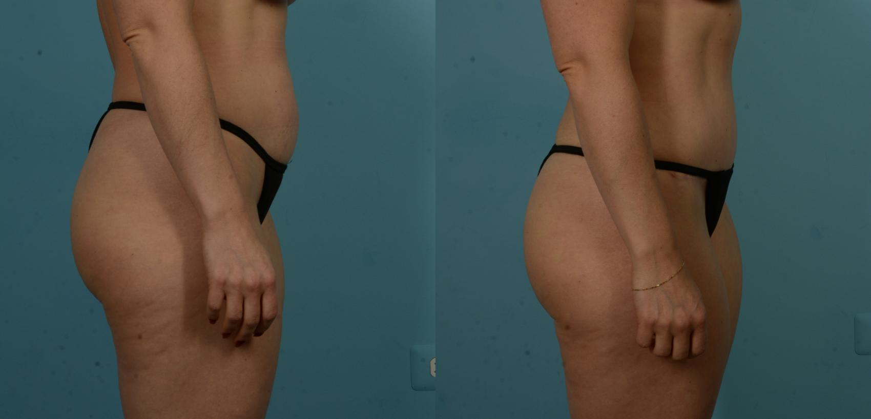 Before & After Tummy Tuck by Dr. Sinno Case 1100 Right Side View in Chicago, IL