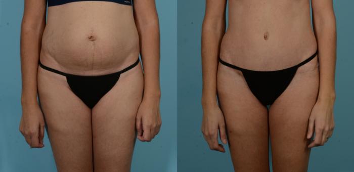 Before & After Tummy Tuck by Dr. Sinno Case 1101 Front View in Chicago, IL