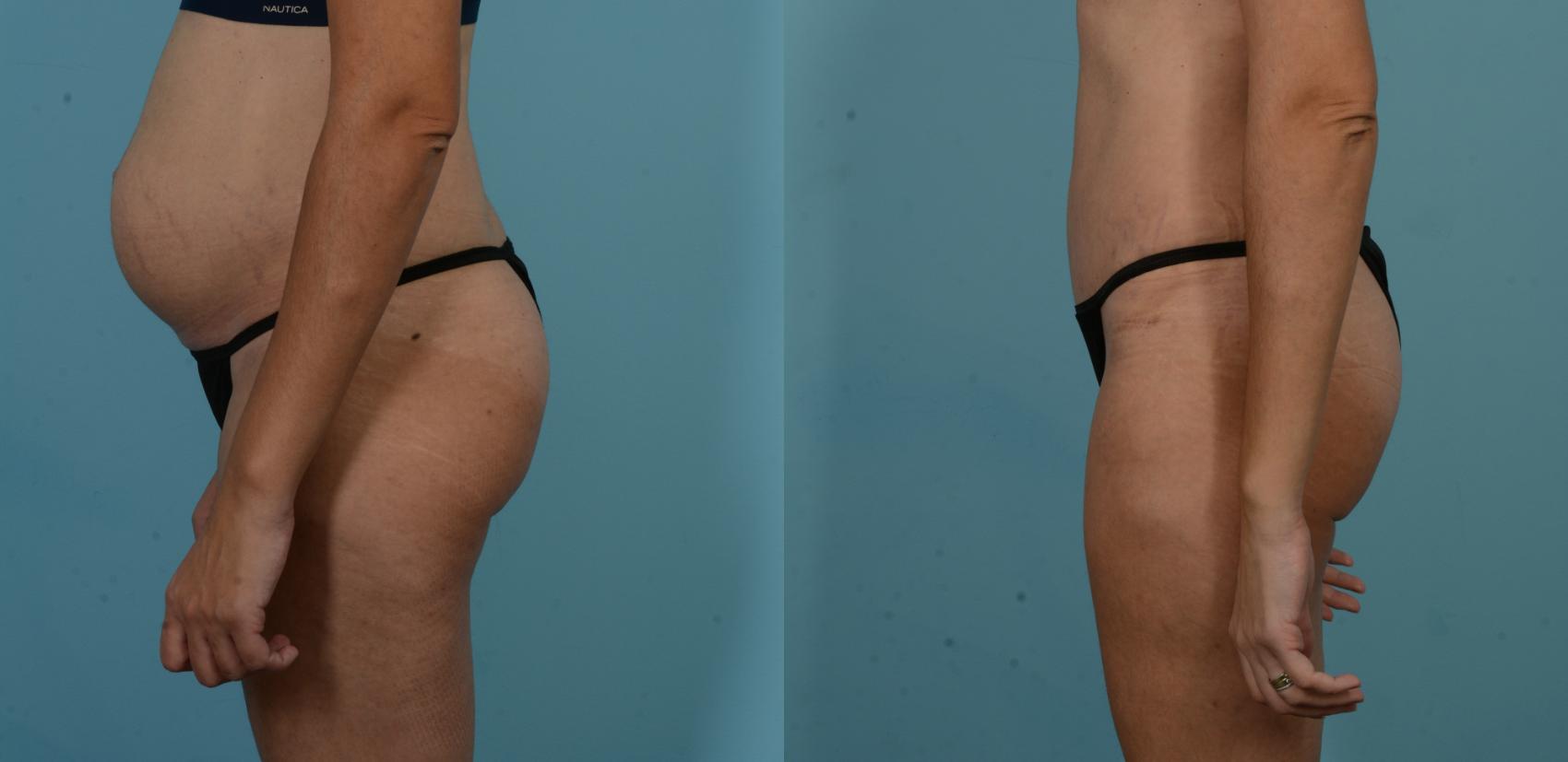 Before & After Tummy Tuck by Dr. Sinno Case 1101 Left Side View in Chicago, IL