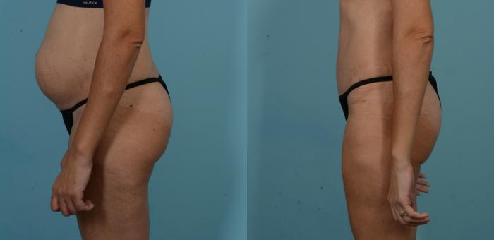 Before & After Tummy Tuck by Dr. Sinno Case 1101 Left Side View in Chicago, IL