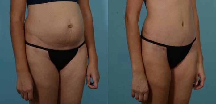 Before & After Tummy Tuck by Dr. Sinno Case 1101 Right Oblique View in Chicago, IL