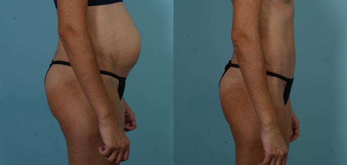 Before & After Tummy Tuck by Dr. Sinno Case 1101 Right Side View in Chicago, IL